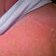 Illustration for article titled The Onions Tips For Treating A Sunburn